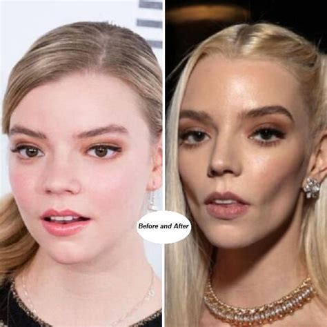 anya joy taylor plastic surgery